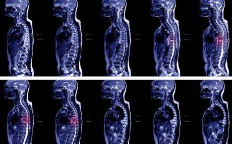 Spinal abscess MRI scan