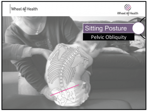 Pelvic Obliquity